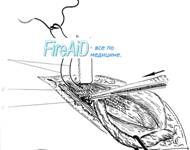 Обработка грыжевого мешка при скользящих грыжах по методу Zimmerman ( Зимерман ).