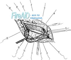 Пластика пахового канала по Бассини (Bassini). Обобщающий рисунок.