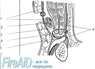 Схема пластики пахового канала по Бассини (Bassini). Схема операции в сагитальной плоскости.