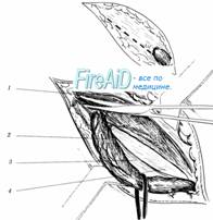 Пластика пахового канала по Постемпсому (Postempsky).