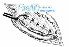 Пластика пахового канала по Постемпсому (Postempsky).