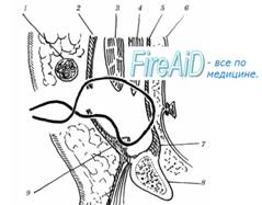 Пластика пахового канала по Постемпсому (Postempsky).