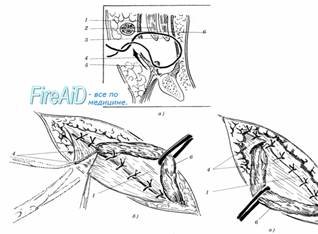 Пластика по модификации Воскресенского-Горелика способа Постемпского.