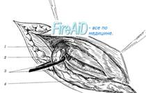 Пластика пахового канала по Шолдайсу ( Шолдайсу, Shouldice).