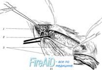 Пластика пахового канала по Шолдайсу ( Шолдайсу, Shouldice).