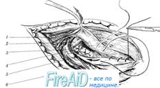 Пластика пахового канала по Шолдайсу ( Шолдайсу, Shouldice).