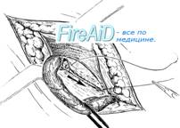 Пластика пахового канала по Шолдайсу ( Шолдайсу, Shouldice).