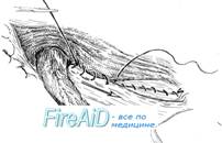 Пластика пахового канала по Шолдайсу ( Шолдайсу, Shouldice).