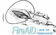 Пластика пахового канала по Шолдайсу ( Шолдайсу, Shouldice).