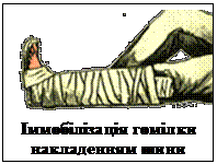 Подпись:  
Іммобілізація гомілки накладенням шини
