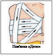 Подпись:      
Пов'язка «Дезо»
