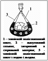 Подпись:  
1 – зовнішній поліетиленовий пакет; 2 – ампутований сегмент, загорнений в стерильний матеріал; 3 - зовнішній поліетиленовий пакет з водою і льодом.
